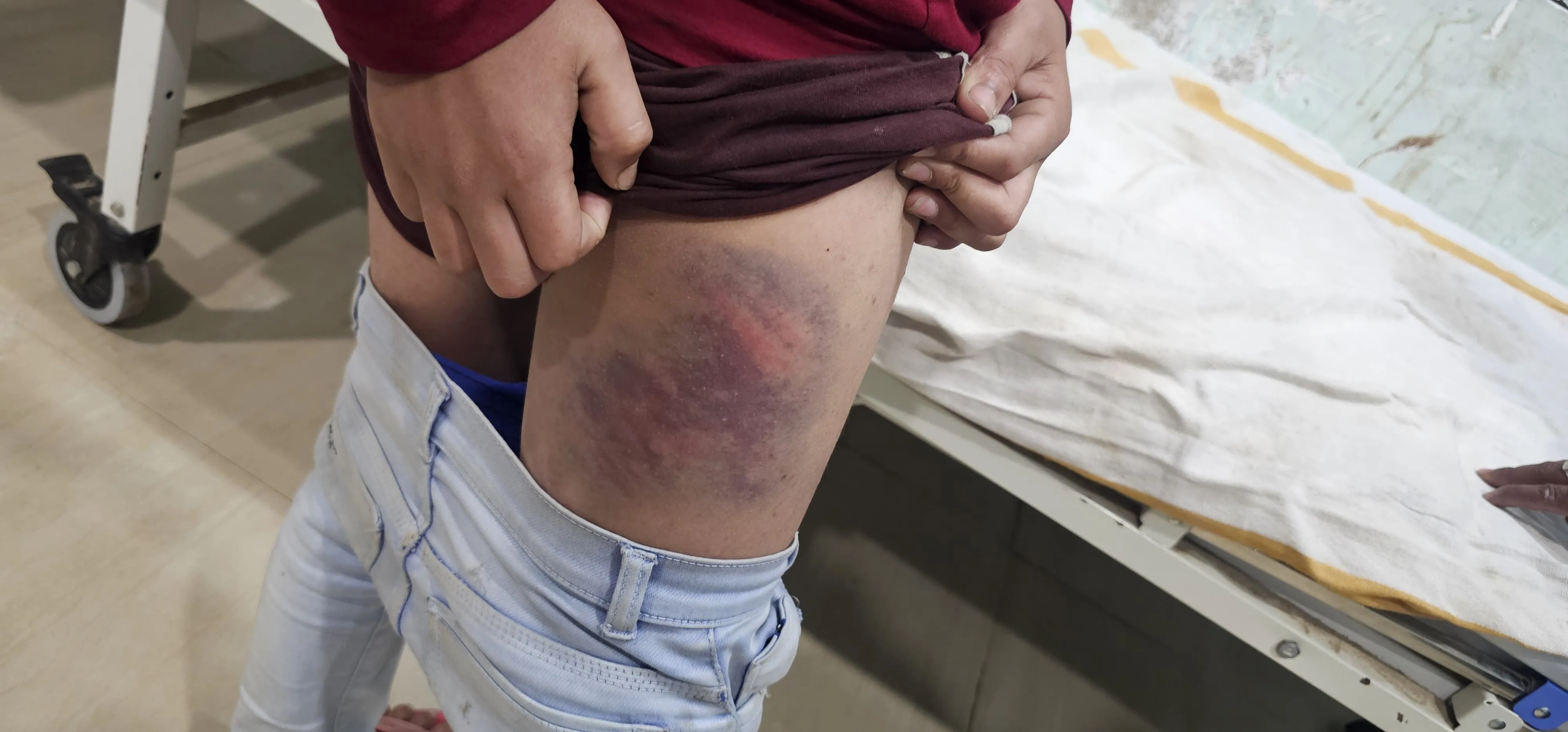 स्कूल में तालिबानी सजा, शिक्षक ने छात्र को वायर से पीटकर किया जख्मी