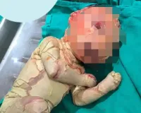 बस्ती के अस्पताल में जन्मा दुर्लभ बीमारी से ग्रसित नवजात, डॉक्टरों ने शुरू की गहन जांच