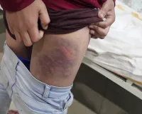 स्कूल में तालिबानी सजा, शिक्षक ने छात्र को वायर से पीटकर किया जख्मी