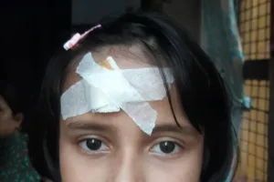 बगहा :  ट्यूशन पढ़ रहे बच्चों पर बन्दरों का हमला के बच्चे घायल