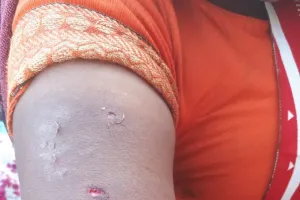 बगहा : गन्ने में डेरा डाला तेंदुआ ग्रामीणों पर कर रहा हमला, एक महिला व पुरुष हुए घायल