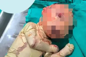 बस्ती के अस्पताल में जन्मा दुर्लभ बीमारी से ग्रसित नवजात, डॉक्टरों ने शुरू की गहन जांच