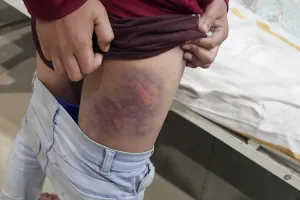 स्कूल में तालिबानी सजा, शिक्षक ने छात्र को वायर से पीटकर किया जख्मी